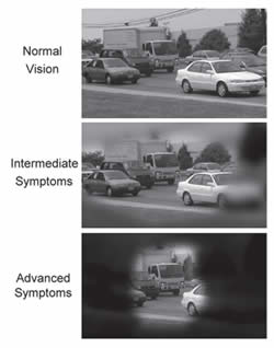 Glaucoma can cause a gradual “tunneling” of vision that often goes unnoticed until permanent sight loss occurs